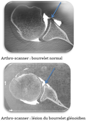 Fig 3 : lésions ligamentaires visibles à l’arthroscanner