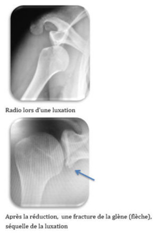 Fig 2 : lésions osseuses visibles à la radiographie