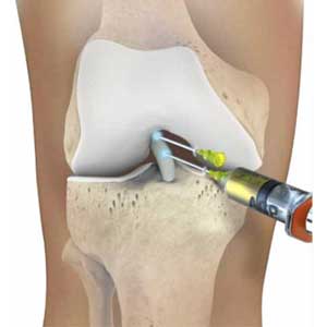 Fig 3 : :injection de PRP au cours d’une arthroscopie de genou