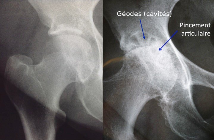 Fig 1 : radio normale de hanche (gauche) / arthrose de hanche (droite)