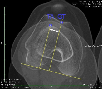 Fig 3 : mesure de la TAGT (mesure du décalage entre l’insertion du tendon rotulien sur le tibia et la trochlée fémorale) au scanner