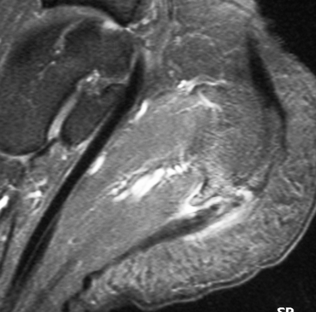 Fig 3 : IRM d’une « épine calcanéenne »
